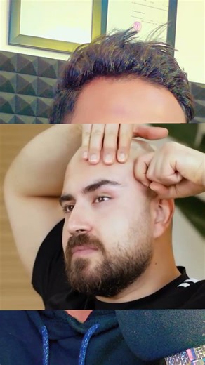 Eye Lift Face Yoga in 30 Seconds | Remove Eye Bags, Dark Circles & Wrinkles Naturally