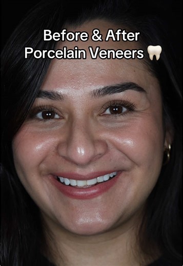 Top 10 Porcelain Veneers Before and After Transformations
