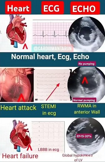 Normal Vs abnormal Echo & ECG🫀 #echocardiography