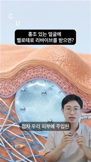 What happens if you get Belotero Revive for facial redness?