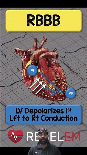 RBBB #REBELEM #ECG #EKG #BundleBranchBlock #rbbbank