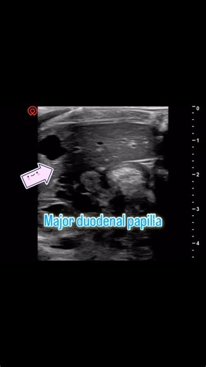 Vision Veterinary Imaging on Instagram: "The major duodenal papilla (papilla of Vater) is the point where the dilated junction of the bile and pancreatic ducts (ampulla of Vater) enter the duodenum. The ampulla is surrounded by the sphincter of Oddi, which not only controls the flow of bile and pancreatic juice into the duodenum, but also prevents the reflux of duodenal contents, bile and pancreatic juice into the bile and pancreatic ducts."