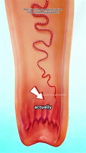 Hemorrhoids Artery Embolization Is Done (3d Animation)