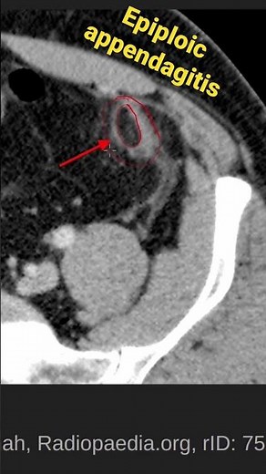 Epiploic appendagitis