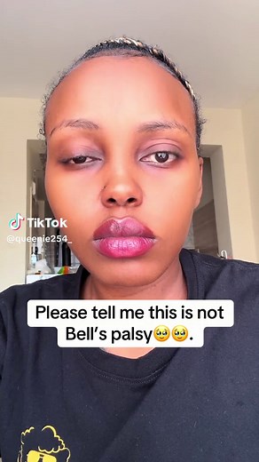 Understanding Bell's Palsy: Symptoms and Causes