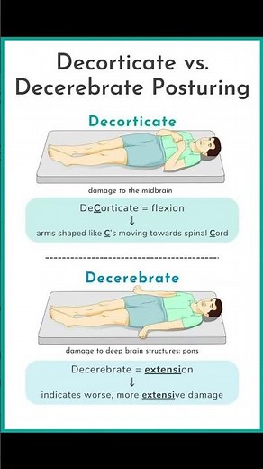 Decorticate and Decerebrate Posturing