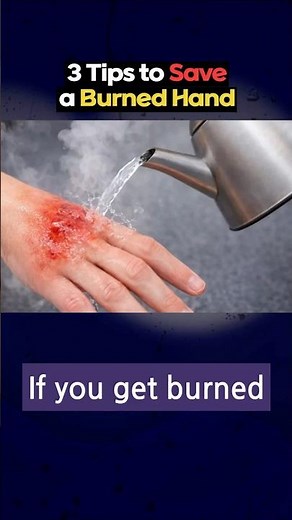 3 First Aid Tips for a Burned Hand l tips for life