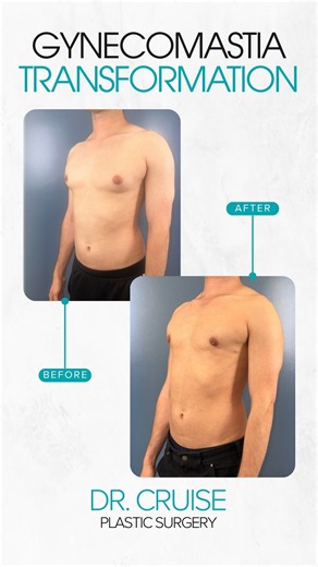 Gynecomastia Surgery Before & After | Male Chest Transformation