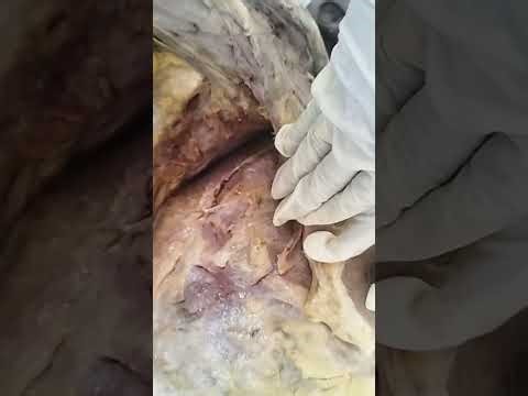 Axilla-Dissection.by.Dr.Veeramalla.