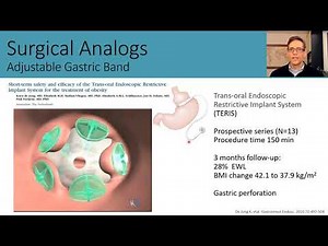 Endoscopic suturing and gastric plication to treat obesity - procedure development and outcomes