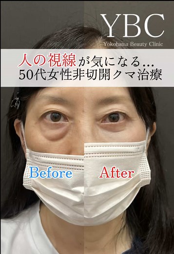 クマ取りの専門技術と安心価格 - YBC美容外科