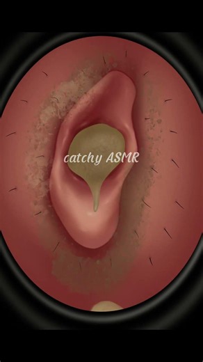 Hard Ear Wax Removal ASMR Animation, Relaxing Ear wax removal Animation, Satisfying ASMR Animation