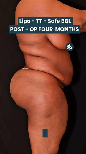 From Flab to Fab! Watch This BBL Glow-Up! #safebbl #plasticsurgery #bblpostop #beforeandafter