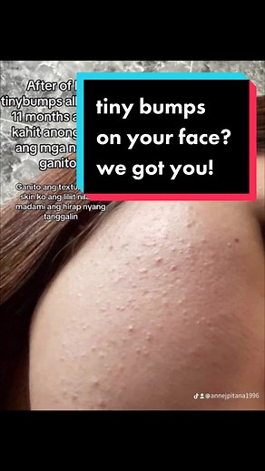 Effective Solutions for Tiny Bumps on Your Face