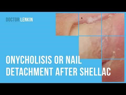 😲​ Onycholisis or nail detachment after shellac