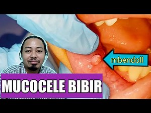 mucocele bibir bawah|benjolen pada bibir bawah
