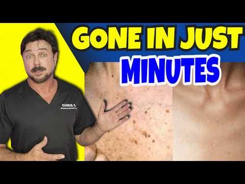 Eradicate Dark Skin Marks And Spots In 2 Minutes