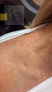 76K views · 1.5K reactions | I’ve done a video on these skin spots...