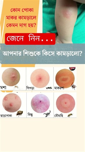 কিভাবে বুঝবেন, আপনার শিশুকে কিসে কামরালো? #babycaretips