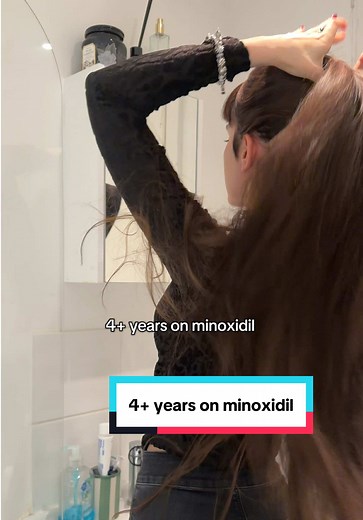 Transformation After 4 Years on Minoxidil