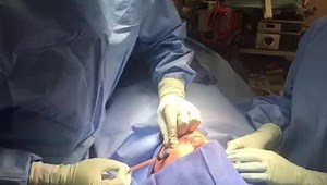 Fat graft transfer to cheeks and lips, scar revision