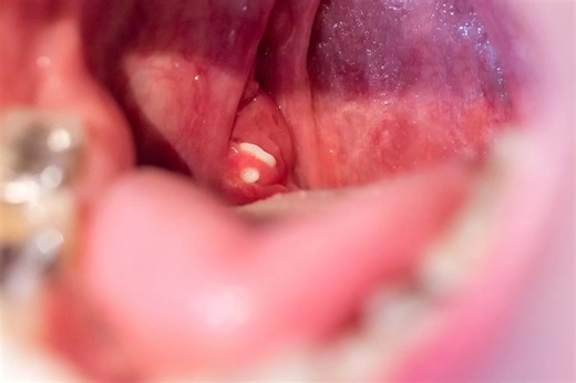 Here's how I knew I had tonsil stones: How an oddly common annoyance upended a patient's quality of life