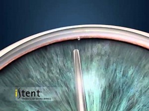 Introducing the iStent from Glaukos Corporation