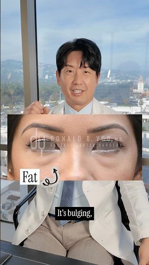 Eyebag removal - lower blepharoplasty #eyebag #plasticsurgery