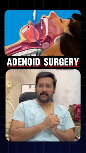 Narayanan Janakiram on Instagram: "Adenoid surgery 🛑 Adenoid surgery, also known as an adenoidectomy, is a procedure to remove the adenoids, which are small glands located behind the nose. This surgery is typically performed on children, most often between the ages of 1 and 7. Adenoids play a role in the immune system by trapping germs, but they can become enlarged or infected, causing problems like breathing difficulties, sleep apnea, and ear infections. 🔸 Difficulty breathing: Enlarged adeno