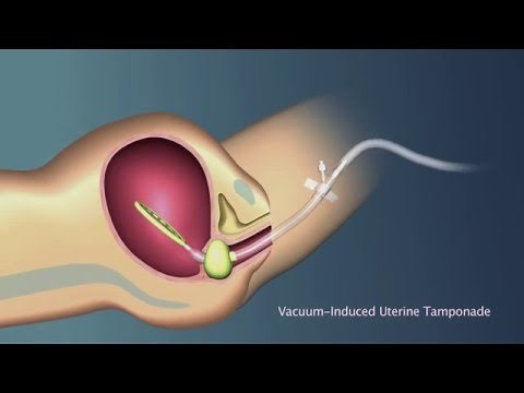 Animated Simulation of Vacuum-Induced Uterine Tamponade for Treatment of Postpartum Hemorrhage