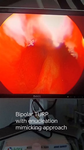 Challenging case today:Prostate size: 200 ccResection time: 120 minutesClear wash“Bipolar transurethral resection of the prostate performed with an enucleation-mimicking approach, aiming to create a wide, smooth, spherical prostatic fossa.”#TURP#HoLEP