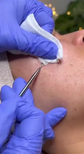 pimples poping asmr #asmr #earwax #pimpleremove #satisfying #sleepsounds