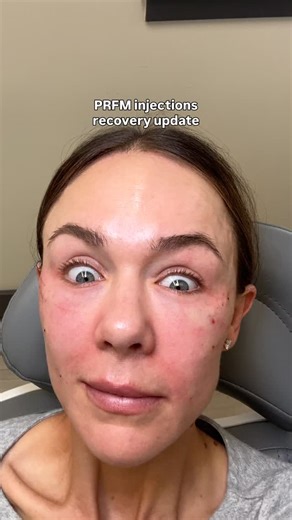 Celeste Thomas, RN, BSN | Acne expert on Instagram: "Nontoxic hollow under eye + crows feet tx 👏🏼 PRFM is a procedure where Platelet rich plasma from your blood is turned into a substance called PRFM (platelet rich fibrin matrix) to stimulate collagen to reduce signs of aging. In this case I had my under eyes treated to reduce hollowing and my crows feet tested to smooth fine lines @alybbeauty What you can expect after you get this treatment ⬇️ Immediately → 72 hours • Swelling, tenderness, re
