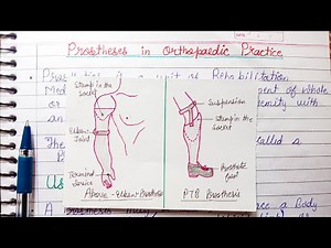 Prosthesis in Orthopaedic Practice - uses ,parts of prosthesis