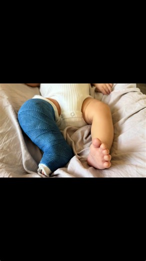My clubfoot warrior. From being terrified at an ultrasound hearing that he’ll have a club foot and wondering what any of that meant to my boy now having perfect feet. What a journey and it’s not even over… 3 more years of treatment for this sweet boy. 💛 my 1 in 1000. #clubfootjourney #clubfoot #clubfootcutie #babiesoftiktok #1in1000