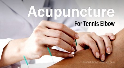 Can Acupuncture Help Your Tennis Elbow Heal?