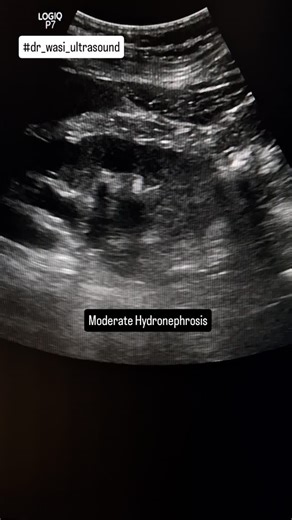 Hydronephrosis with ureteric calculus in ureterocele #hydronephrosis #uretericcalculus #ureterocele #kidneydisease #ureter #kidneycalculus #renalultrasound #kidneyultrasound #prostatomegaly #bph #urinarybladder #dr_wasi_ultrasound #ultrasonography #radiologist #neetpg #medicaleducation #abdominalultrasound #ultrasounds #medicalimaging | Ultrasound made easy