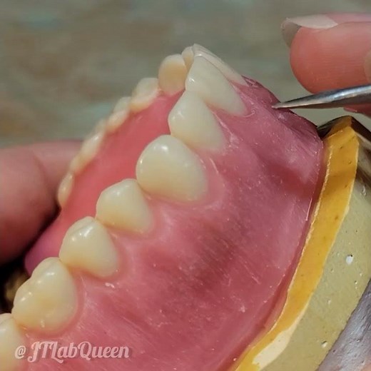 Maxillary Denture Wax up