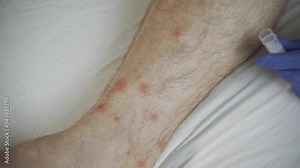 The doctor diagnoses Dry skin, Psoriasis of the feet. The skin is damaged. Dermatitis, eczema, psoriasis, allergic reaction. Close-up - peeling and cracking on the foot of a person. Fungal infection