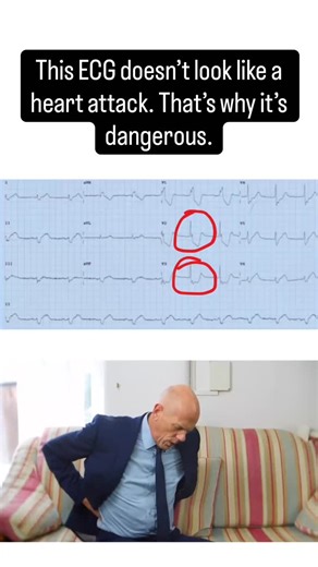 Learn ECGs Fast | JMD Medical Ed on Instagram: "If a fire is burning in the back room of a house, you don’t see flames from the front. You see smoke. Posterior MI is the fire. ST depression in V1 to V3 is the smoke. He walked into ED chatting. Chest pain earlier. Now “much better”. ECG printed. Someone says, “No STEMI.” That sentence has ended careers. Look at V1 to V3. ST segments pushed down. Horizontal. Not dramatic. Just… there. Here’s the mistake. People call this anterior ischemia and move