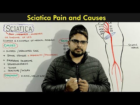 Sciatica: Symptoms, Causes and Treatments of Sciatic nerve