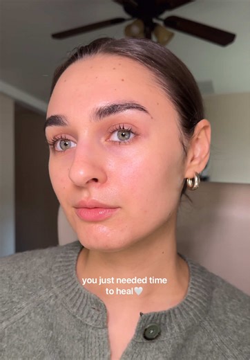 5-Year Acne Transformation Journey and Healing Tips