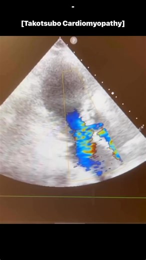 Takotsubo Cardiomyopathy | Cardiophilia