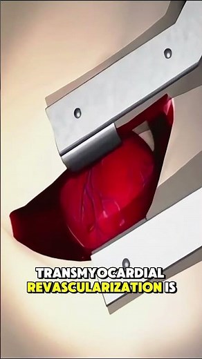 Transmyocardial Revascularization Explained (3D Animation)#heartsurgery #cardiacsurgery#medical3d
