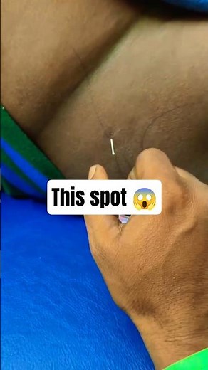 Upper Hamstring Dry Needling | Glute Trigger Point Release