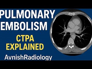 “Pulmonary Embolism on CTPA | Easy Radiology Guide | ‪@Philips‬ ‪@avnishradiology‬