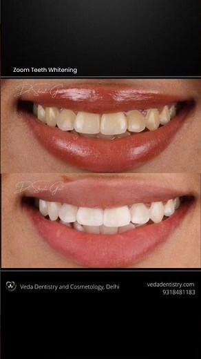 Years of Stains Gone in One Appointment #Zoomteethwhitening