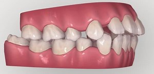 Invisalign to reduce crowding and lip profile