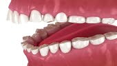 Dental attrition resulting in loss of tooth tissue. Dental 3D...