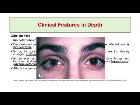 Fuchs’ Uveitis Syndrome: Explained From A to Z